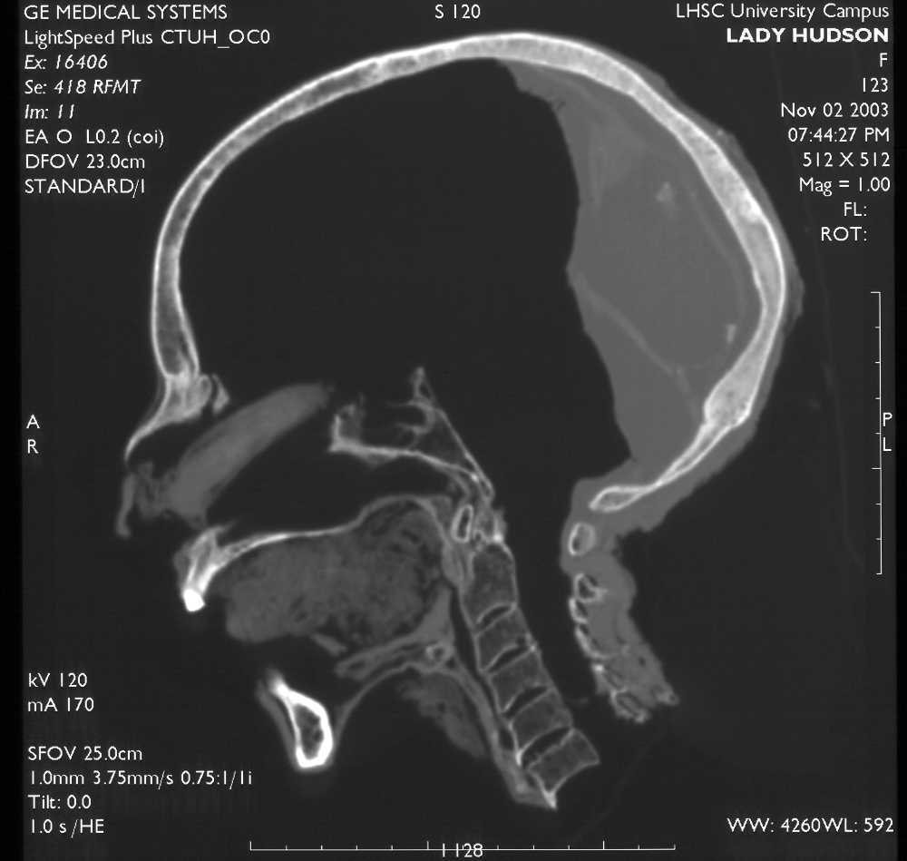 A CT slice through the midline of the head of a mummy—Lady Hudson—showing that her brain was removed through her nose and resin poured into the rear of the skull. Image courtesy of Andrew Nelson, University of Western Ontario.